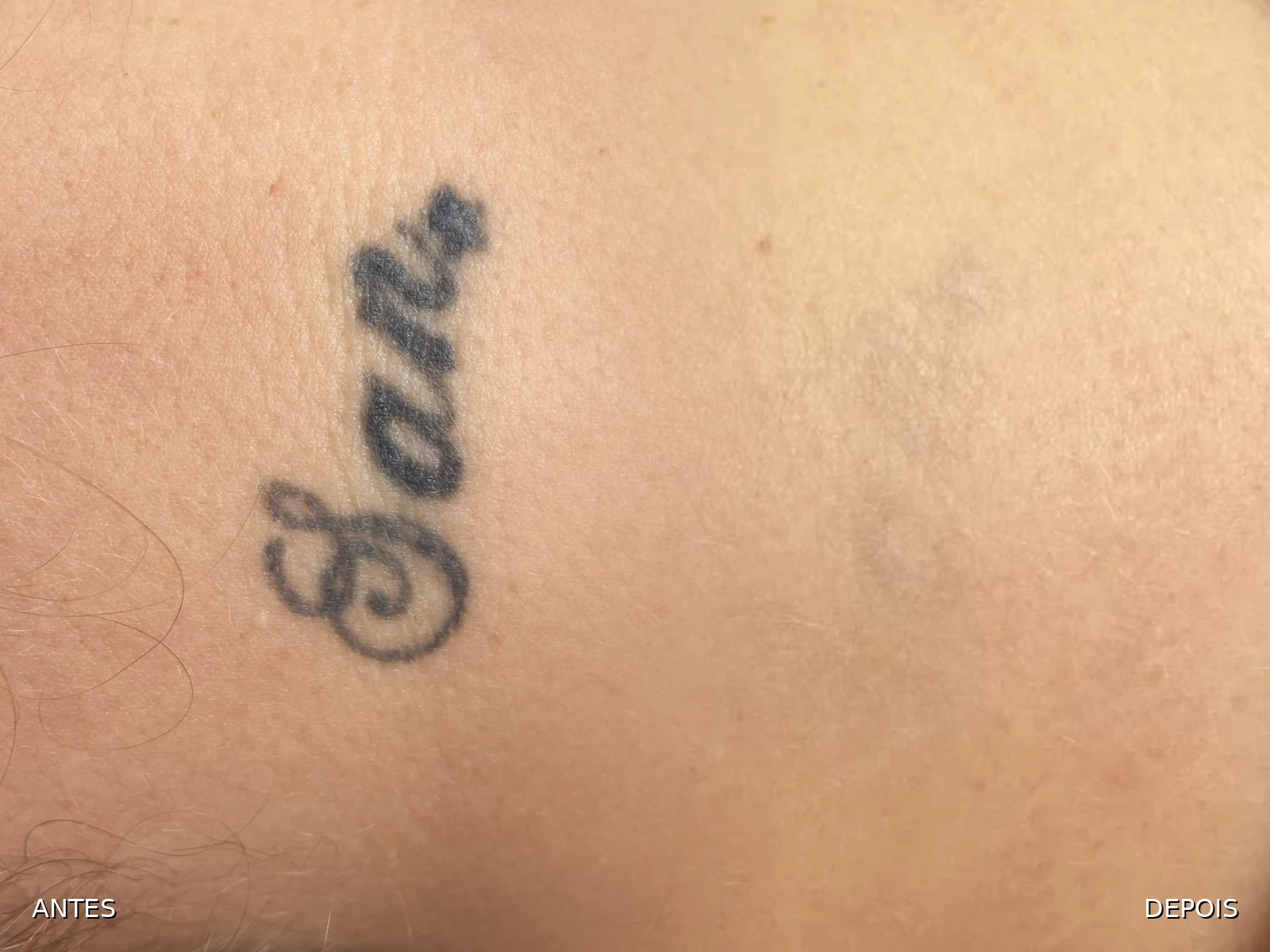 Antes e depois da remoção de uma tatuagem de letras na nuca: à esquerda a tatuagem escura, à direita a pele após as sessões, com a marca quase imperceptível
