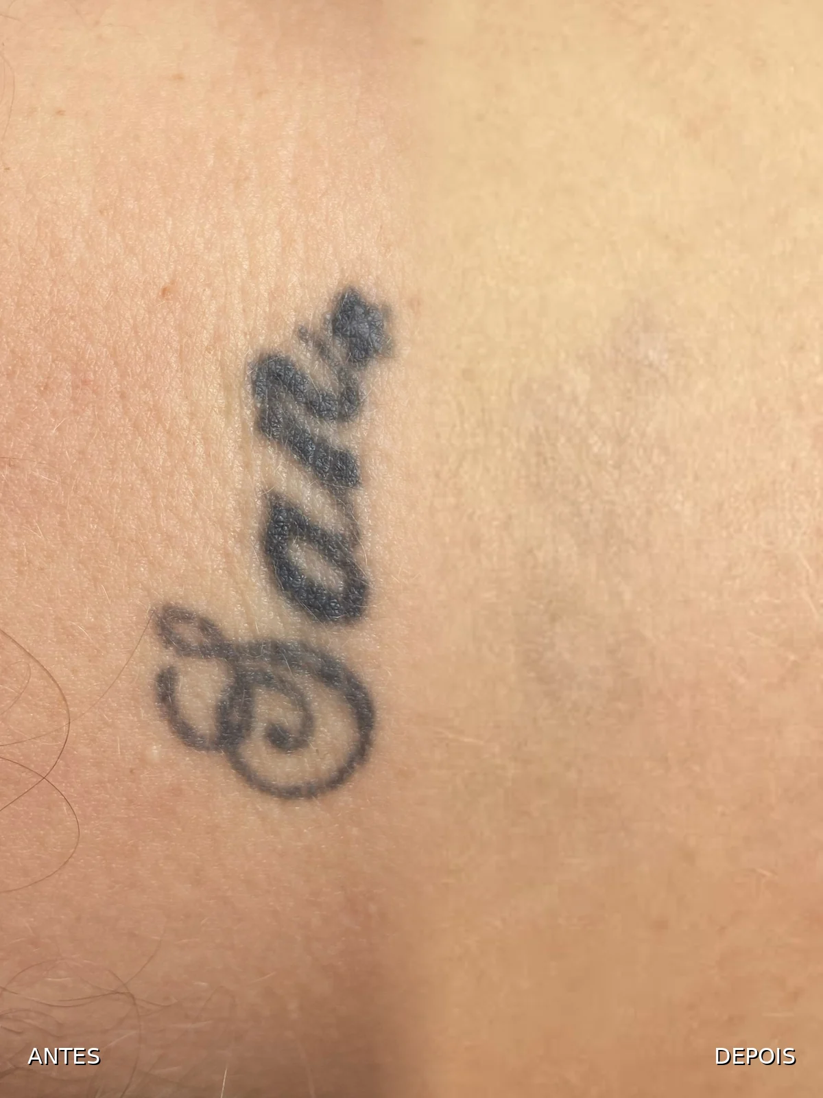 Ambiente editorial de remoção de micropigmentação e tatuagem